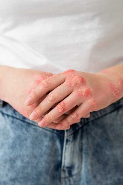 Metronidazole and Rashes