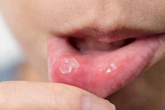 Metronidazole dry mouth