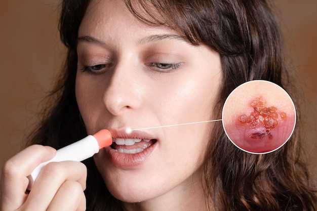 Oral metronidazole for skin infection